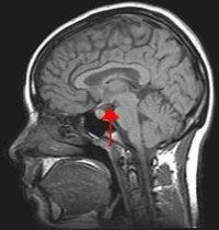 Situaci&oacute;n do hipot&aacute;lamo no cerebro